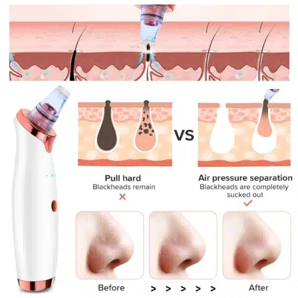 Vacuum Blackhead Remover Face Pore Cleaner – Deep Skin Cleaning Tool
